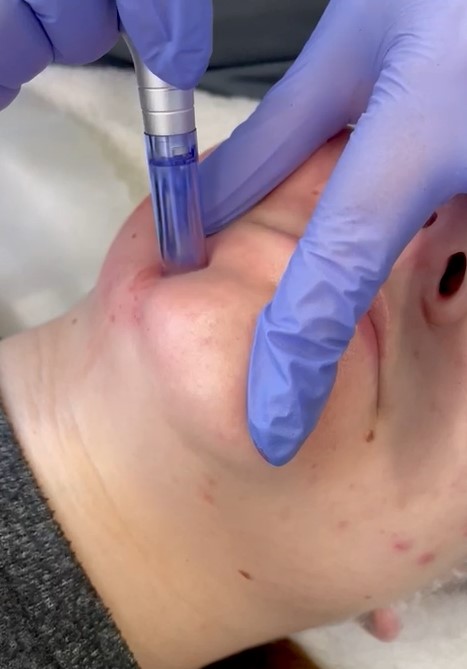 DERMAPEN – Mezoterapia mikroigłowa