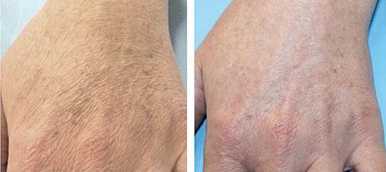 Zabiegi odmładzające na dłonie