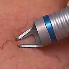 Laser diodowy Capilaser 980nm Laser Diodowy na popękane naczynka