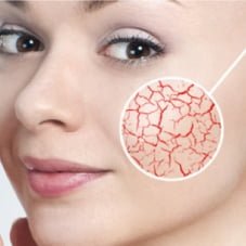 Usuwanie rumienia, przebarwień, zamykanie naczynek laserem