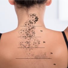 Laserowe usuwanie tatuażu makijażu permanentnego