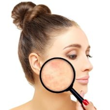 Usuwanie rumienia, przebarwień, zamykanie naczynek laserem