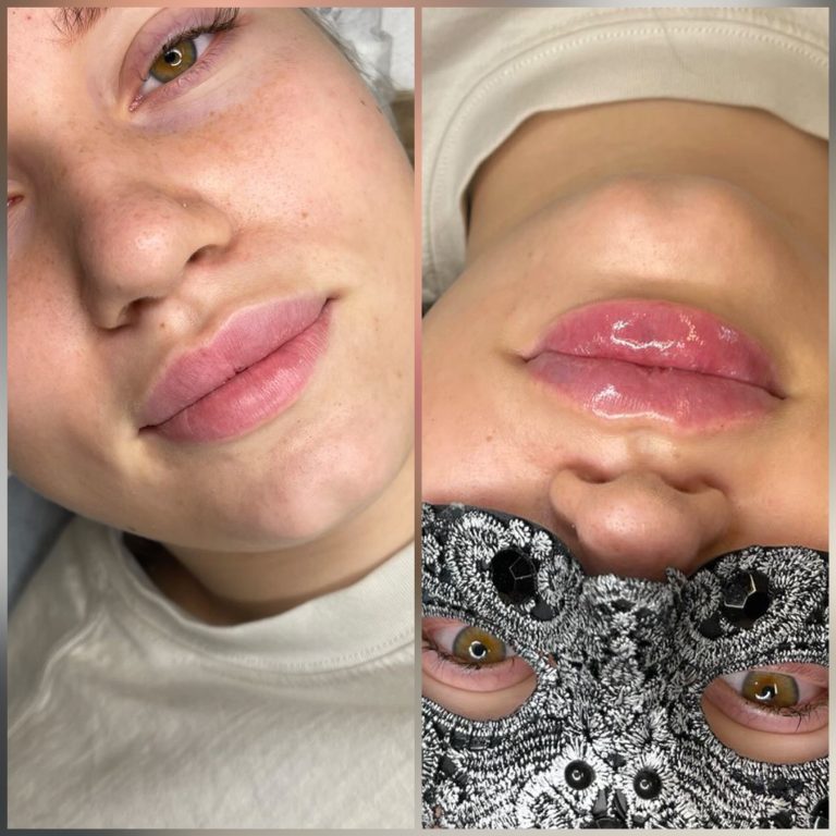 Powiększanie ust oraz modelowanie - Klinika Urody Warszawa