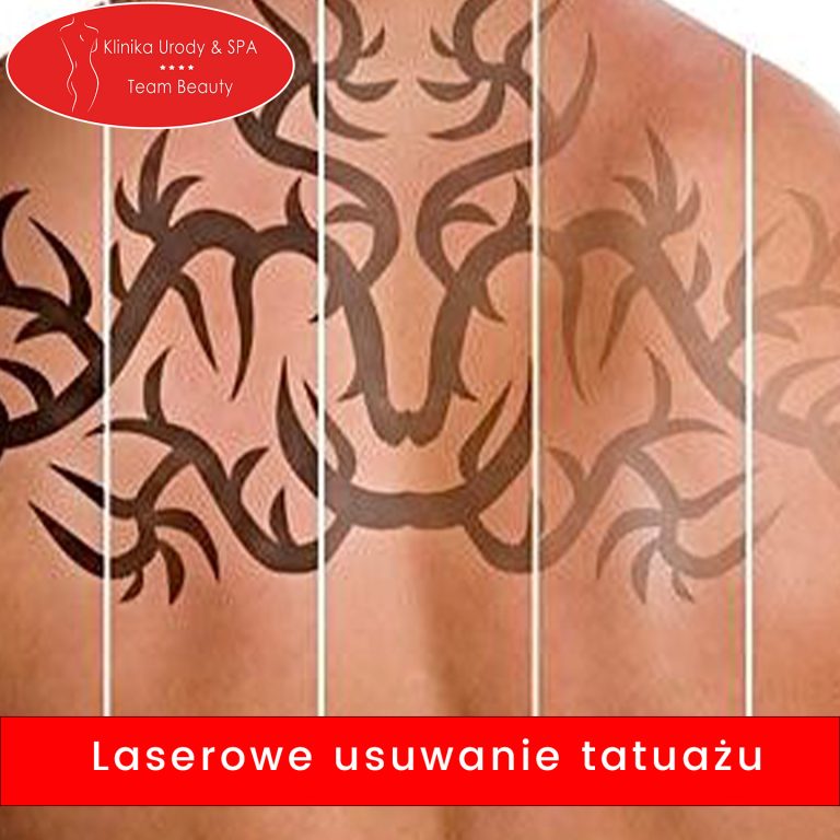 Laserowe Usuwanie Tatuażu: Skuteczne Metody i Nowoczesne Rozwiązania w Warszawie