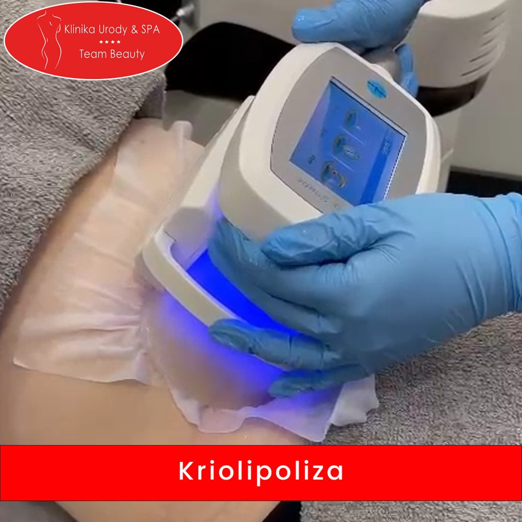 kriolipoliza -Zabieg kriolipolizy polega na zamrożeniu tkanki tłuszczowej