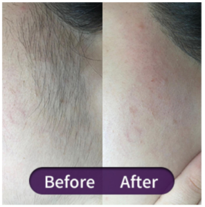 efekt depilacji laserowej SHR