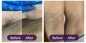 efekt depilacji laserowej SHR